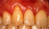 牙齦萎縮-四項牙齦萎縮的原因:常吃四種瓜果蔬菜能有效的護理牙齒!