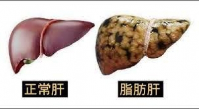 脂肪肝成因&amp;脂肪肝症狀-中醫消除脂肪肝的五招方法:長期脂肪肝可能演變成肝硬化或肝癌記得適當處置!