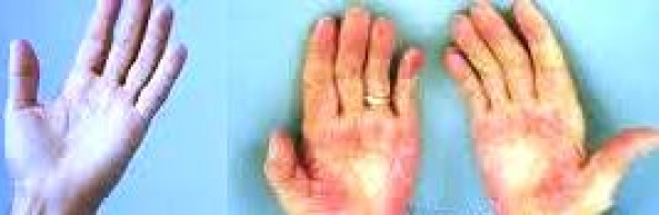 肝病&amp;肝掌-肝症狀攤開手掌看肝臟健康&amp;養肝秘訣:肝好不好看手掌就知道!