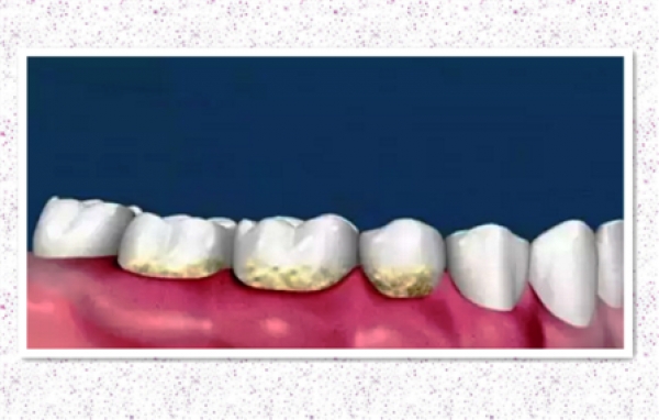 洗牙&amp;牙結石-四個超簡單去牙結石的洗牙方法:在家解決牙結石免去醫院洗牙!